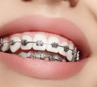 Traditional Braces