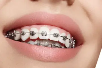 Traditional Braces