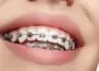 Traditional Braces