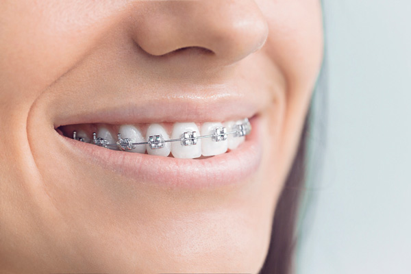 Traditional Braces